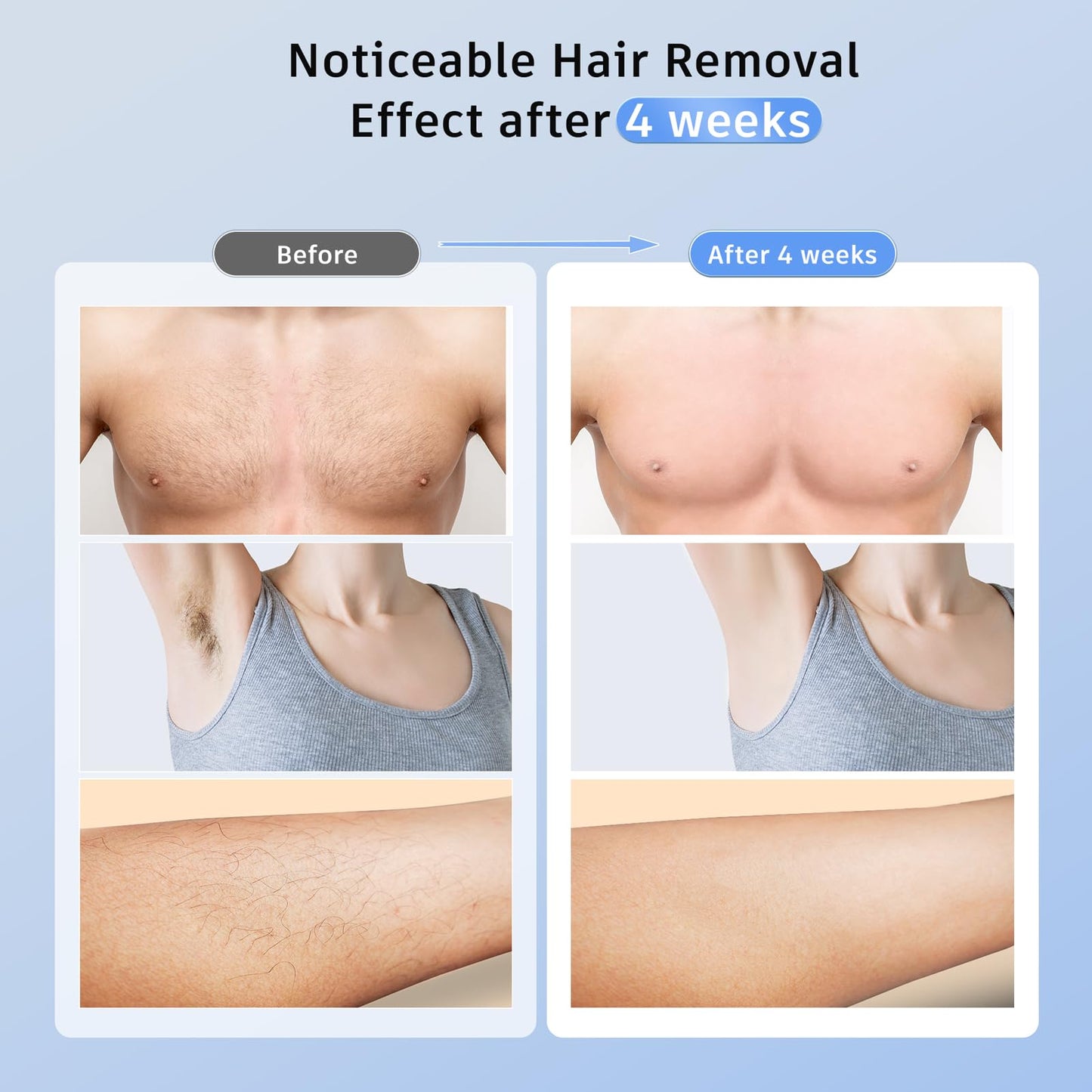 IPL Hair Removal Device for Home Use
