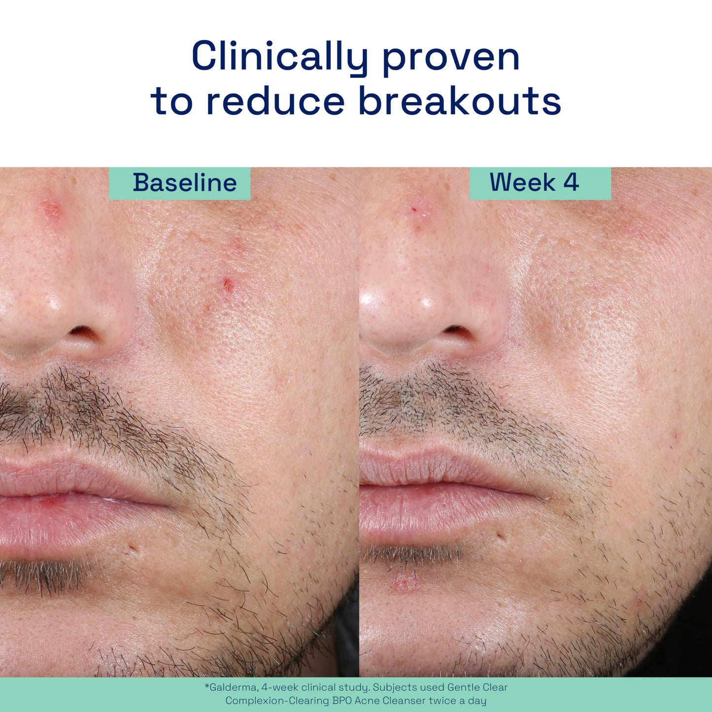 Cetaphil Acne Cleanser with 2.6% Benzoyl Peroxide