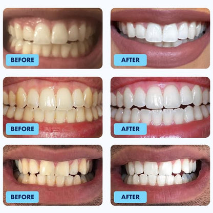 Glimmer LED Teeth Whitening Kit with Gel Syringes