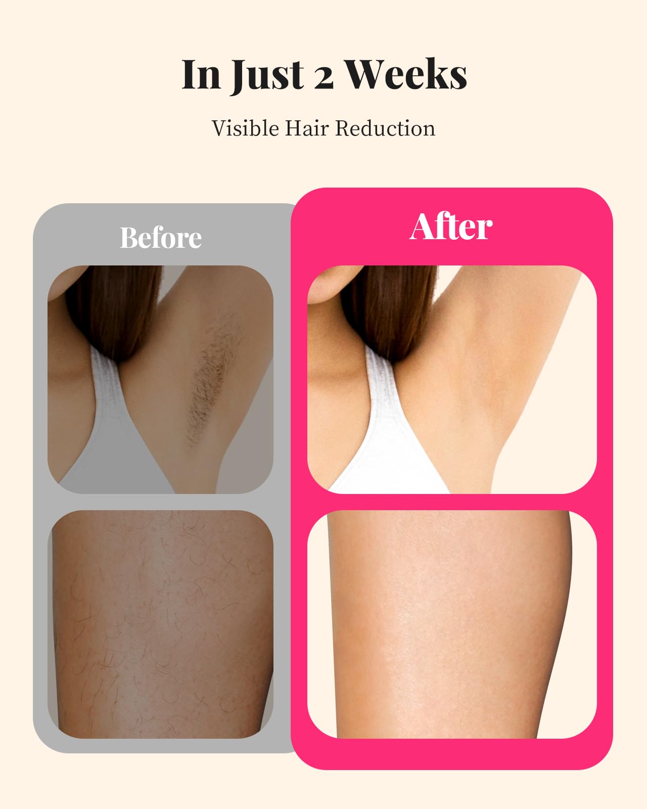 LYSMOSKI IPL Laser Hair Removal Device for Home