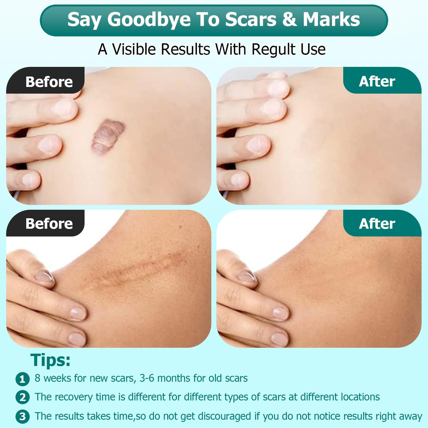 Gowgaw Scar Gel, Scar Cream, Advance Scar Gel for Surgical Scars,Face,Body,Leg, Burns, Acene,C-Section, Stretch Marks, Keloids,Scar Treatments for Old & New Scars,Scar Removal for Women Men,1.76oz